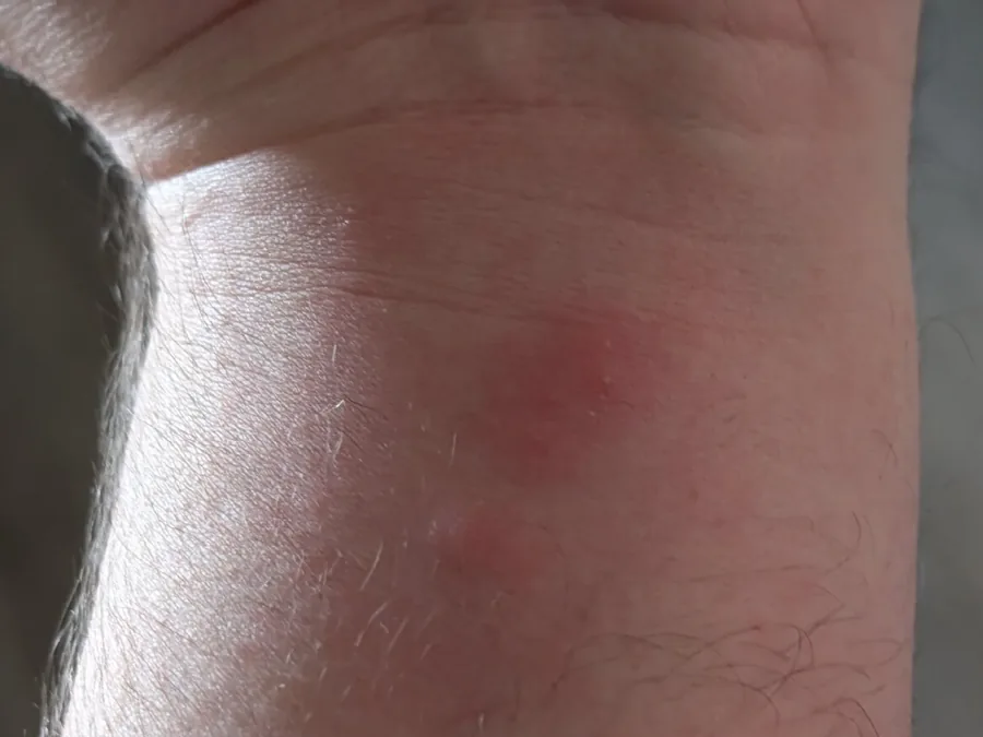 A bed bug bite on a tenant's wrist