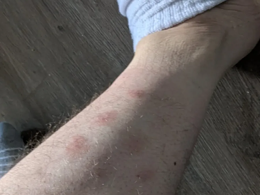 Bed bug bites on a tenant's forearm