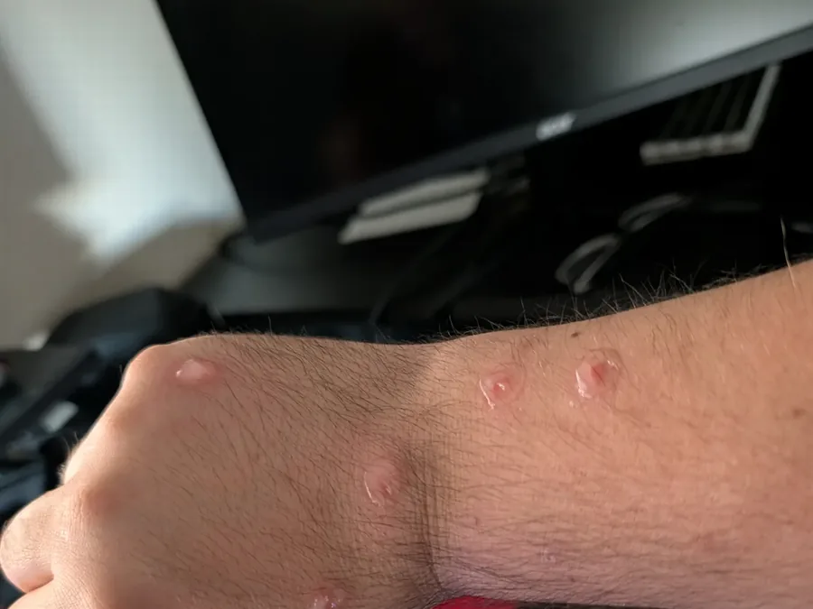 Bed bug bites on a tenant's hand and wrist