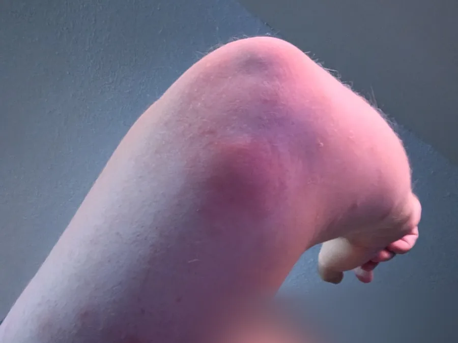 A large inflamed bed bug bite on a tenant's elbow
