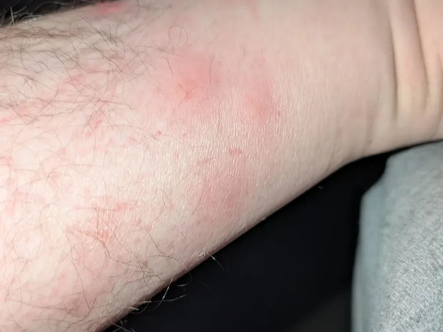 Clusters of bed bug bites on a tenant's arm