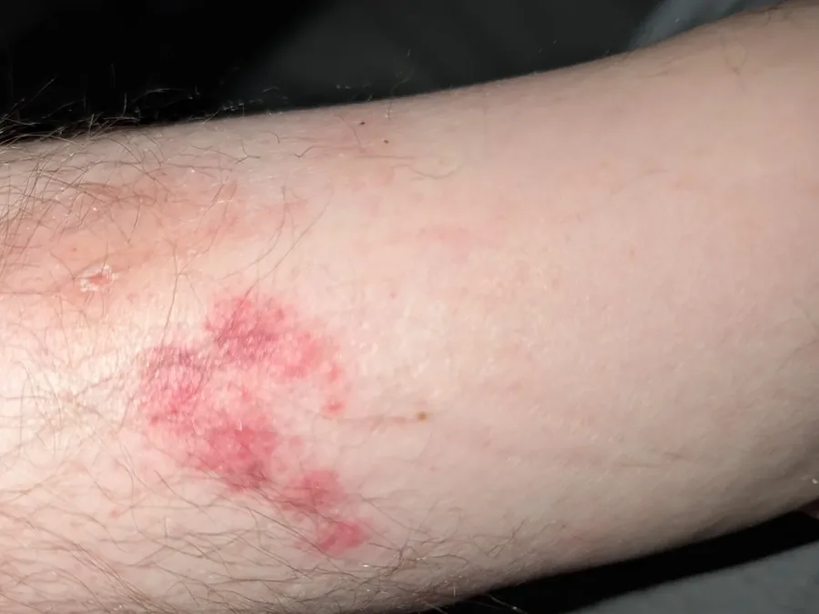 Bed bug bites and scratch marks on a tenant's forearm
