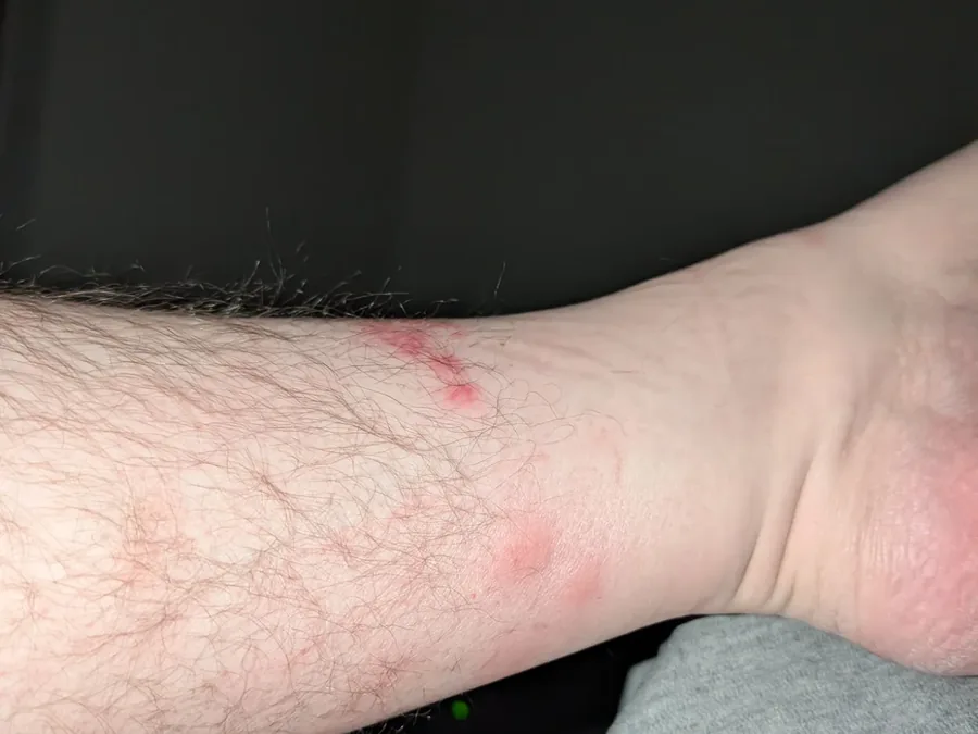 Bed bug bites on a tenant's wrist